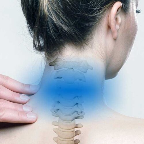 artrosi cervicale