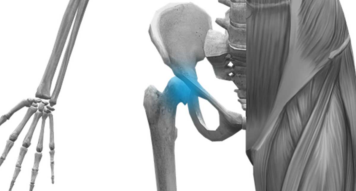 La coxartrosi o artrosi dell’anca: sintomi, cure e terapie